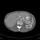 Nutcracker syndrome, aortomesenteric compression: CT - Computed tomography